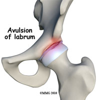 hip-labral