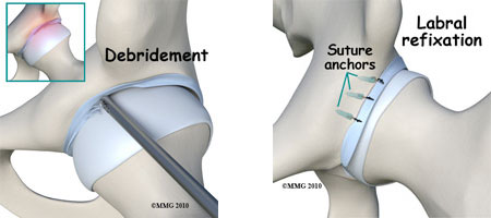 hip-labral2