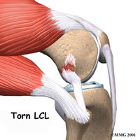 knee-lcl-collateral-1
