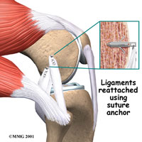 knee-lcl-collateral-2