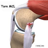 knee-mcl-collateral-1