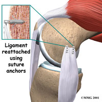 knee-mcl-collateral-2