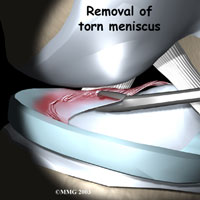 knee-meniscus-partial