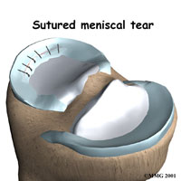 knee-meniscus-repair