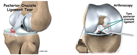 knee-pcl