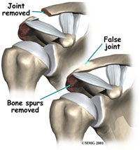 shoulder-acjoint-2