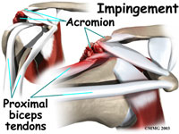 shoulder-biceps-tendonitis2