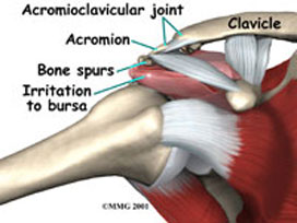 shoulder-impingement