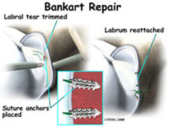 shoulder-instability-unstable