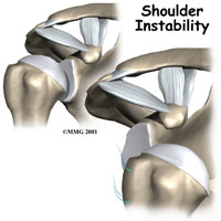 shoulder-instability