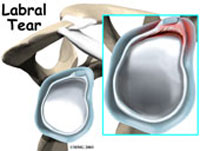 shoulder-labral-fig1