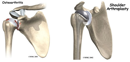 shoulder-replacement