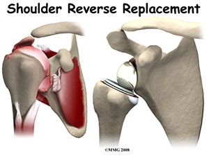 shoulder-reverse