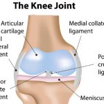 meniscus tear