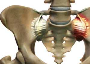 Inflamed SI Joint