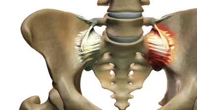 Sacroiliac (SI) Joint Pain - Total Spine and Orthopedics